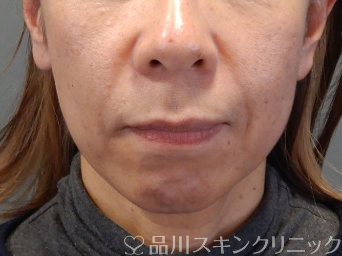 症例NO.72336のBEFORE写真