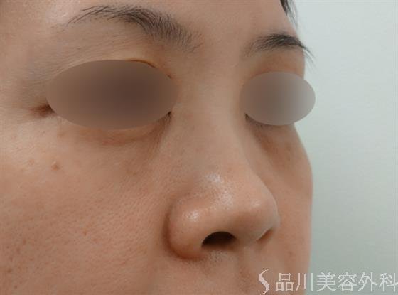 症例NO.25034のBEFORE写真