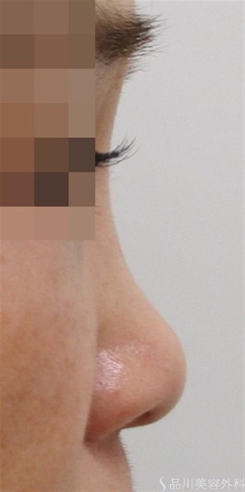 症例NO.44025のBEFORE写真