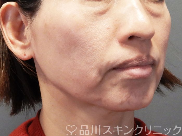 症例NO.72853のBEFORE写真