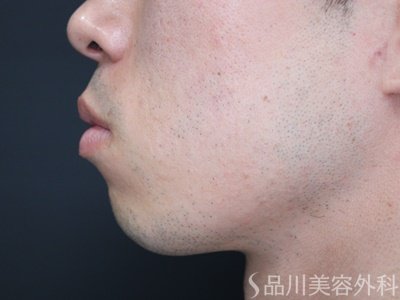 症例NO.67598のBEFORE写真