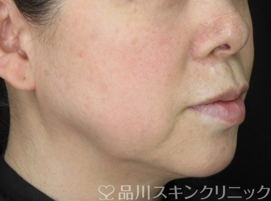 症例NO.70042のBEFORE写真
