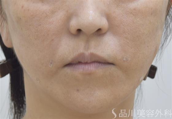 症例NO.46599のAFTER写真