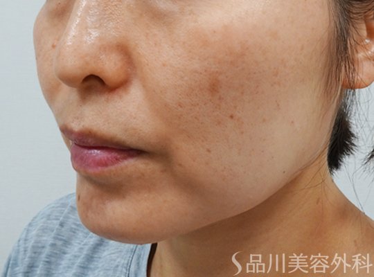 症例NO.73393のBEFORE写真