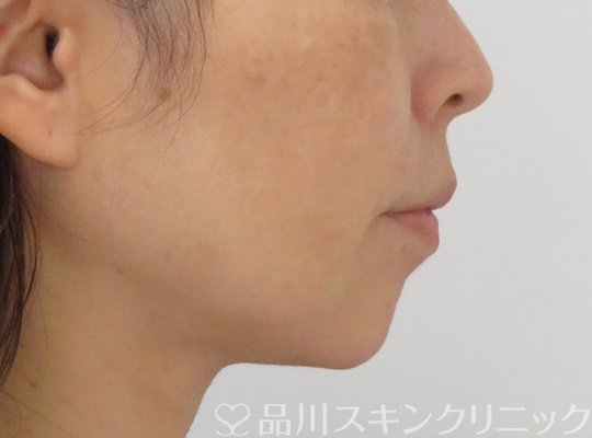 症例NO.71114のAFTER写真