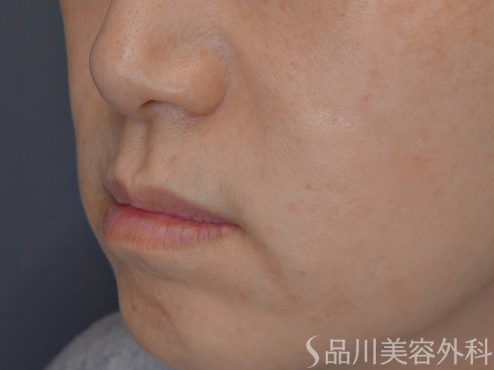 症例NO.72391のBEFORE写真