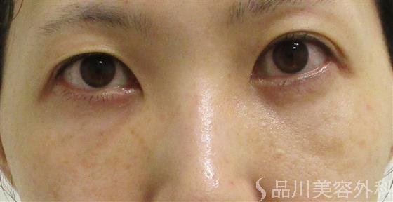 症例NO.55966のAFTER写真