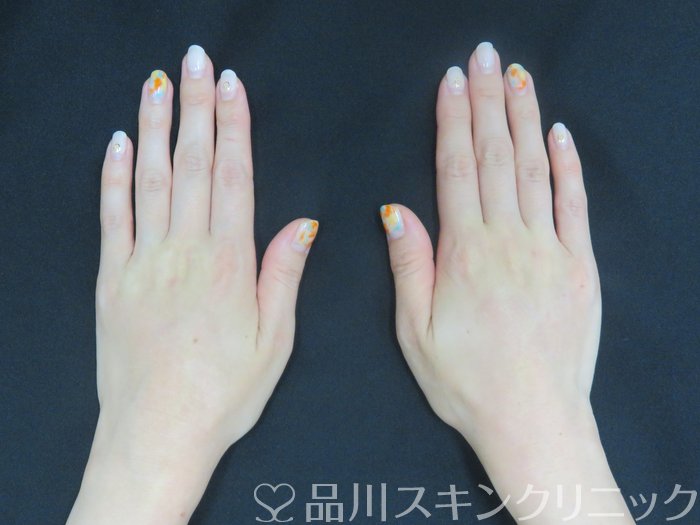 症例NO.70348のAFTER写真