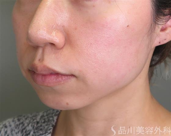 症例NO.49070のBEFORE写真