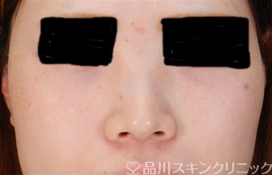 症例NO.60996のBEFORE写真