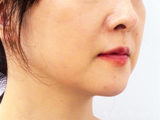 症例NO.52522のBEFORE写真