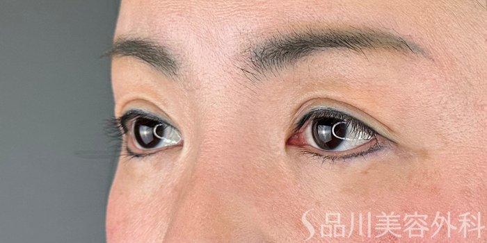 症例NO.69462のAFTER写真