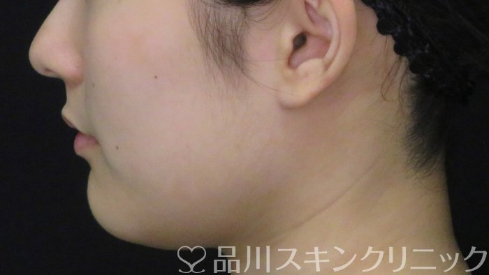 症例NO.70840のBEFORE写真