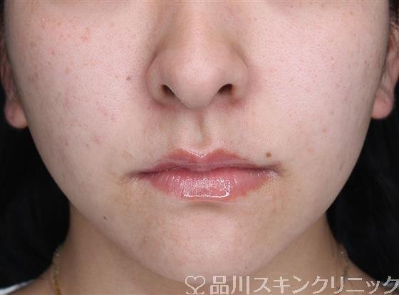 症例NO.60767のAFTER写真