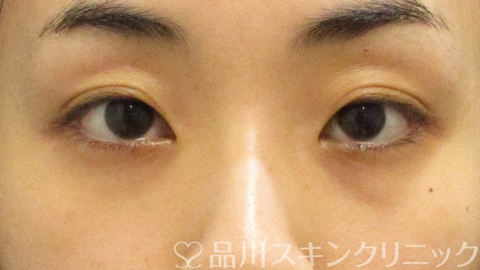症例NO.70919のAFTER写真