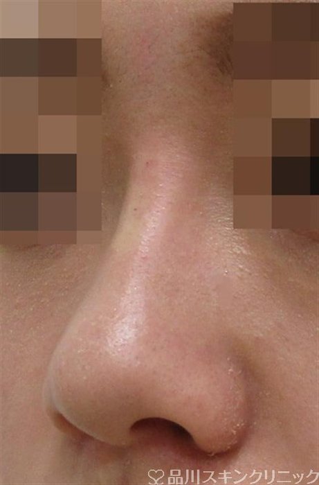 症例NO.42154のAFTER写真
