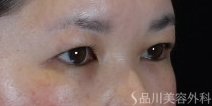症例NO.74782のAFTER写真