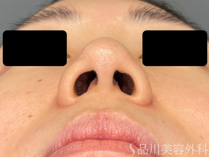 症例NO.65576のBEFORE写真
