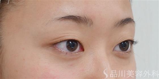 症例NO.34467のBEFORE写真