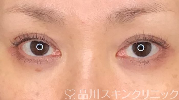 症例NO.63646のAFTER写真