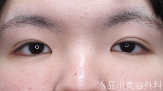 症例NO.73559のAFTER写真