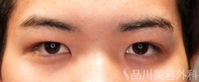 症例NO.71065のBEFORE写真