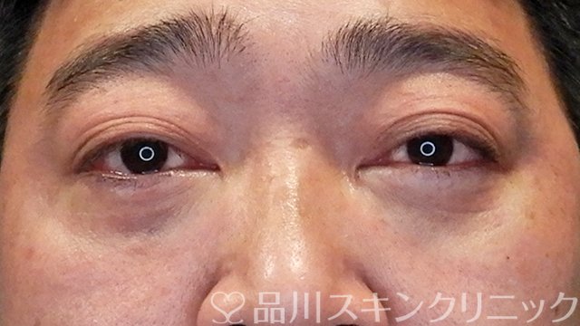 症例NO.64614のAFTER写真