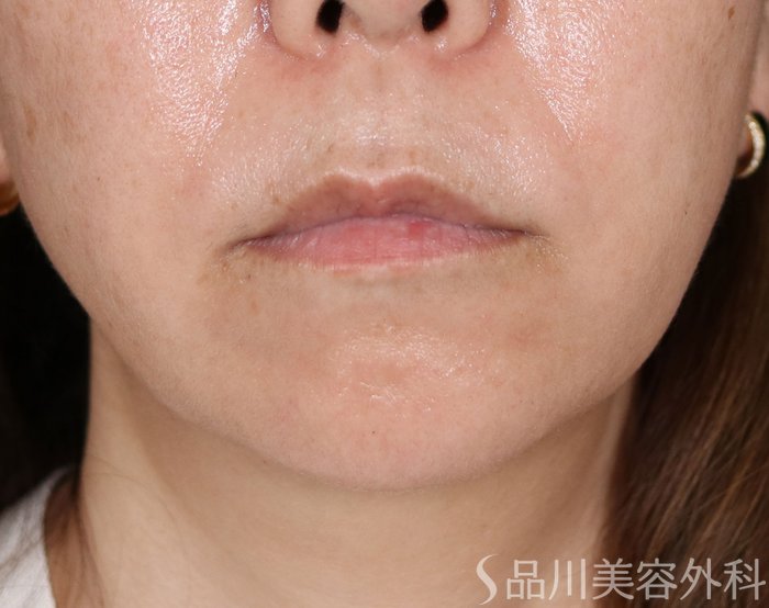 症例NO.71908のBEFORE写真