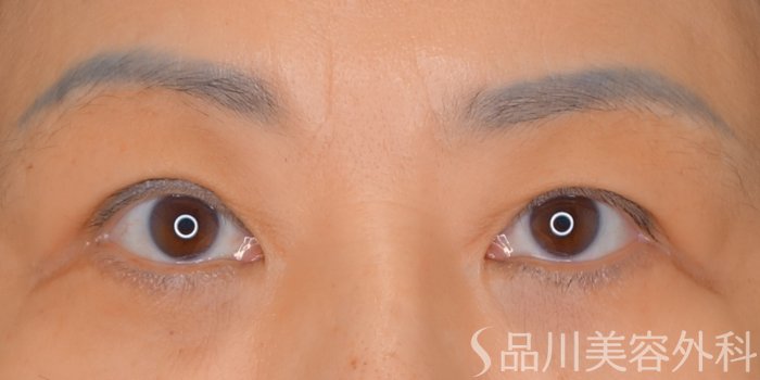 症例NO.70655のBEFORE写真