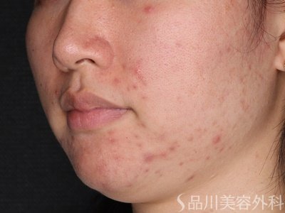 症例NO.74451のBEFORE写真