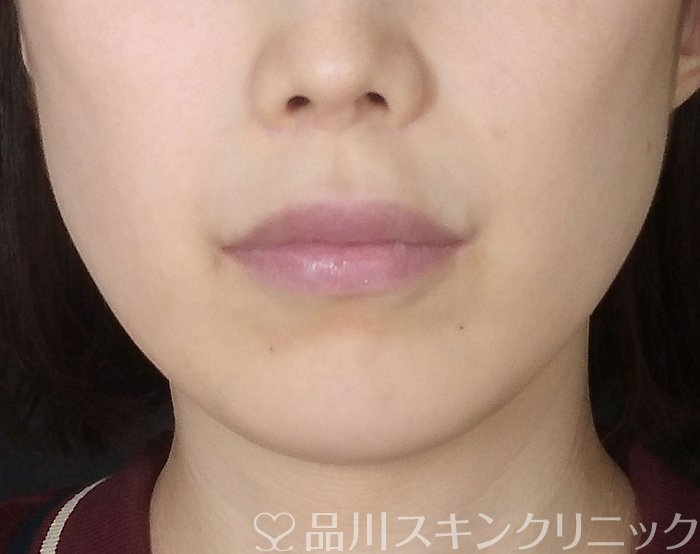症例NO.69939のBEFORE写真