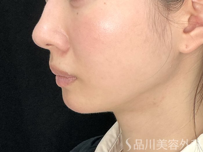 症例NO.71630のAFTER写真