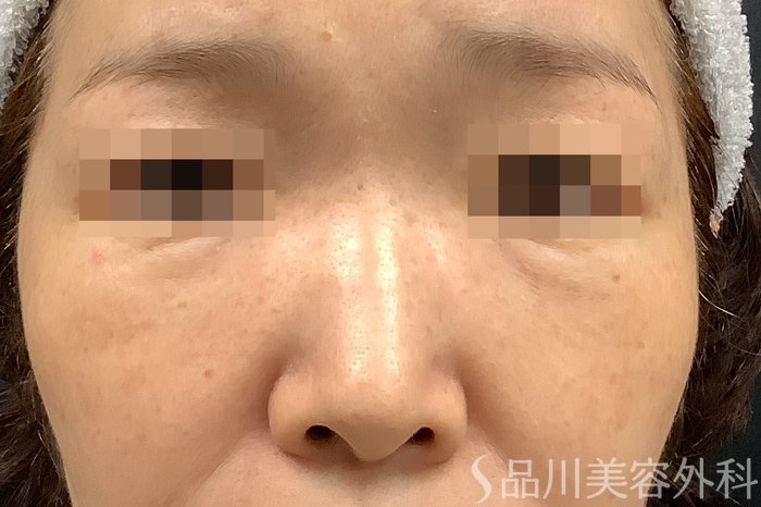 症例NO.71256のBEFORE写真