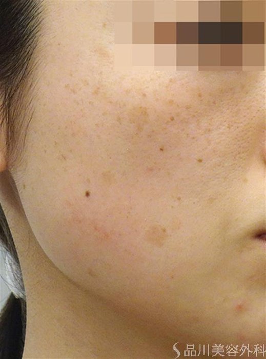 症例NO.24578のBEFORE写真