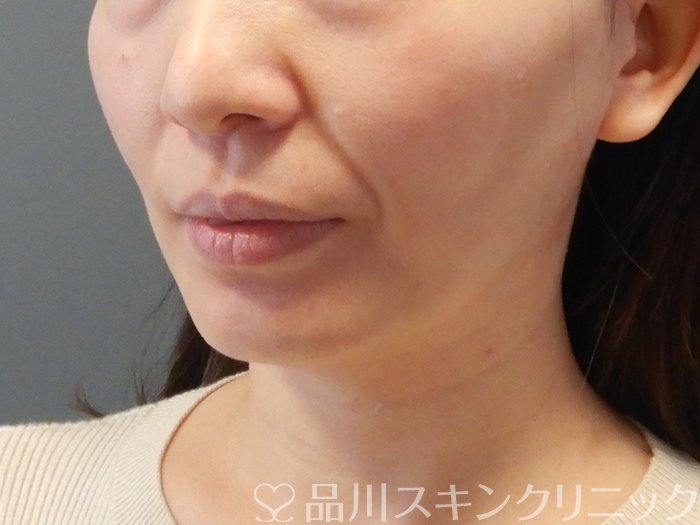 症例NO.63836のBEFORE写真