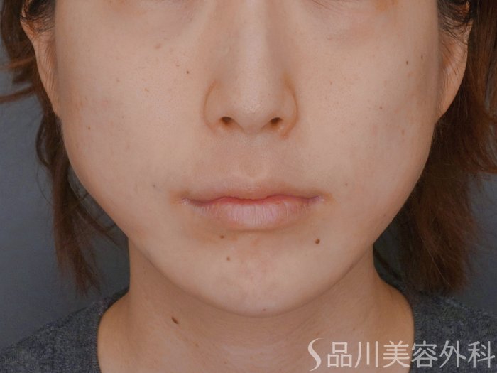 症例NO.73636のAFTER写真