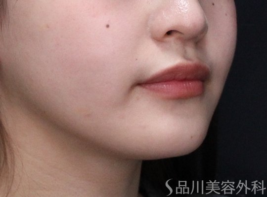 症例NO.73871のAFTER写真