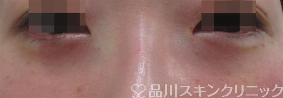 症例NO.29320のAFTER写真