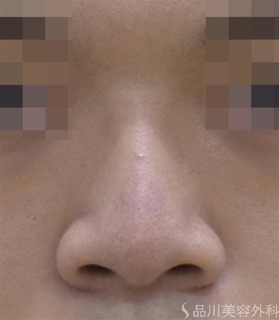 症例NO.48137のAFTER写真