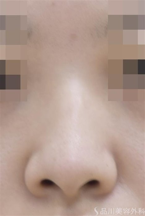 症例NO.46734のBEFORE写真