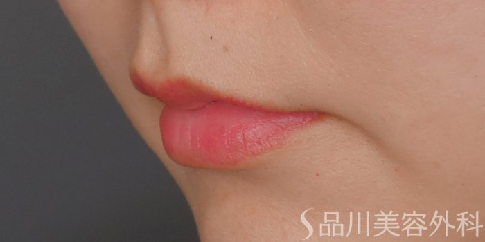 症例NO.71763のBEFORE写真