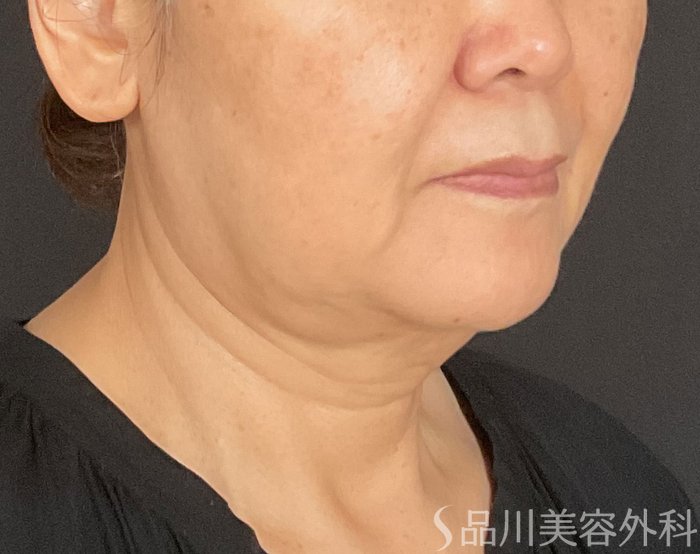 症例NO.74783のBEFORE写真
