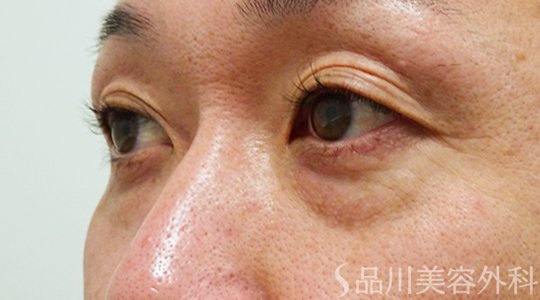 症例NO.71142のBEFORE写真