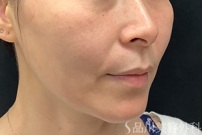 症例NO.71252のBEFORE写真