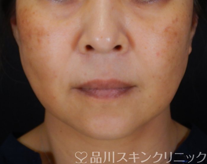 症例NO.66743のAFTER写真