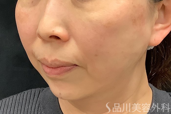 症例NO.73326のAFTER写真