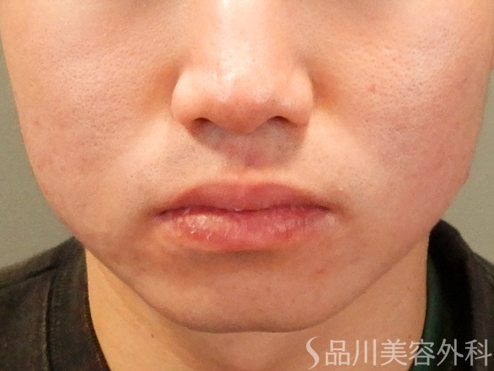 症例NO.70245のBEFORE写真