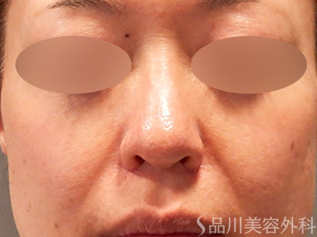 症例NO.69576のAFTER写真