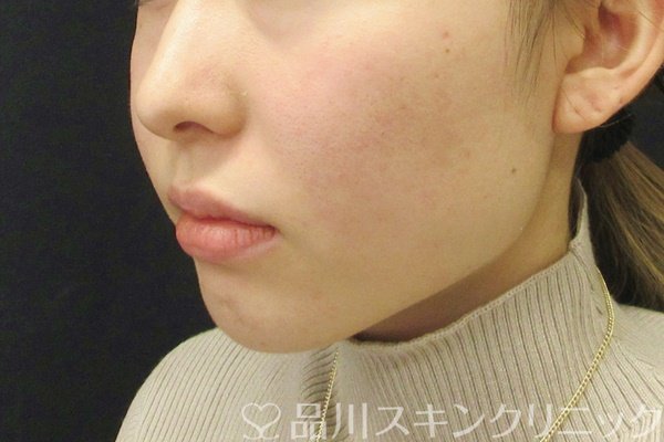 症例NO.68365のBEFORE写真