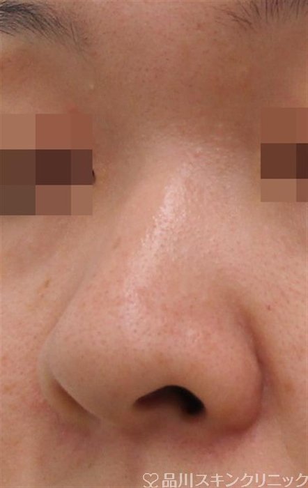 症例NO.36172のBEFORE写真